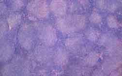 Follicular mixed 

lymphoma